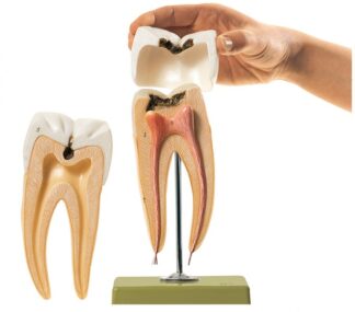 Molar tand med caries-0