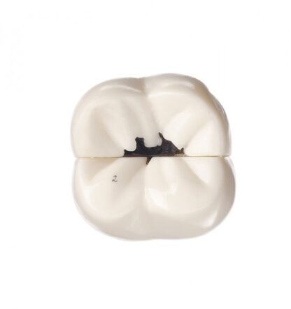 Molar tand med caries-10874
