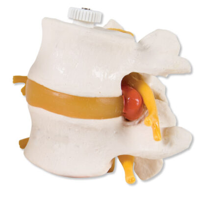 2 Lumbar Vertebrae with pro-lapsed disc, flexibly mounted