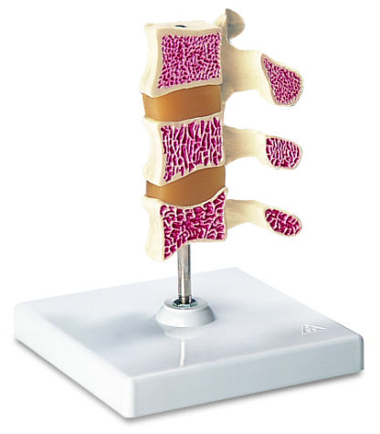Deluxe Osteoporose Model (3 ryghvirvler)-7271